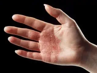 ถุงมือแพทย์: อาการแพ้ถุงมือแพทย์